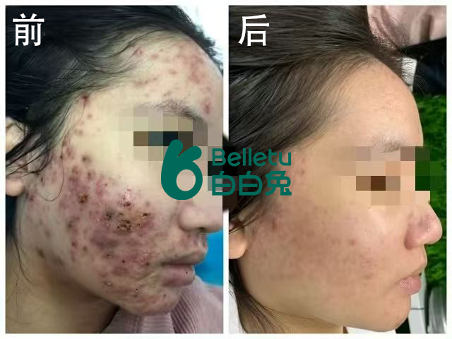 白白兔门店皮肤改善案例
