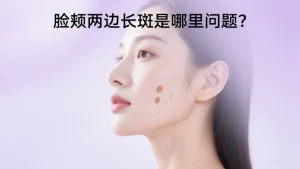 脸颊两边长斑是哪里问题？