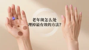 老年斑怎么处理掉最有效的方法