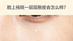 脸上祛斑一层层脱皮会怎么样？