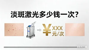 淡斑激光多少钱一次