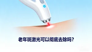 老年斑激光可以彻底去除吗？