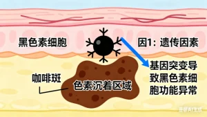 咖啡斑是什么原因引起的小孩子?