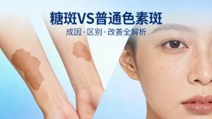 糖斑长什么样子?和普通色素斑区别？如何改善？