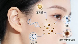 脸颊两侧长斑原因？