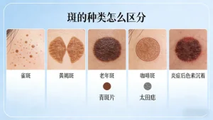 斑的种类怎么区分？一篇吃透不踩坑